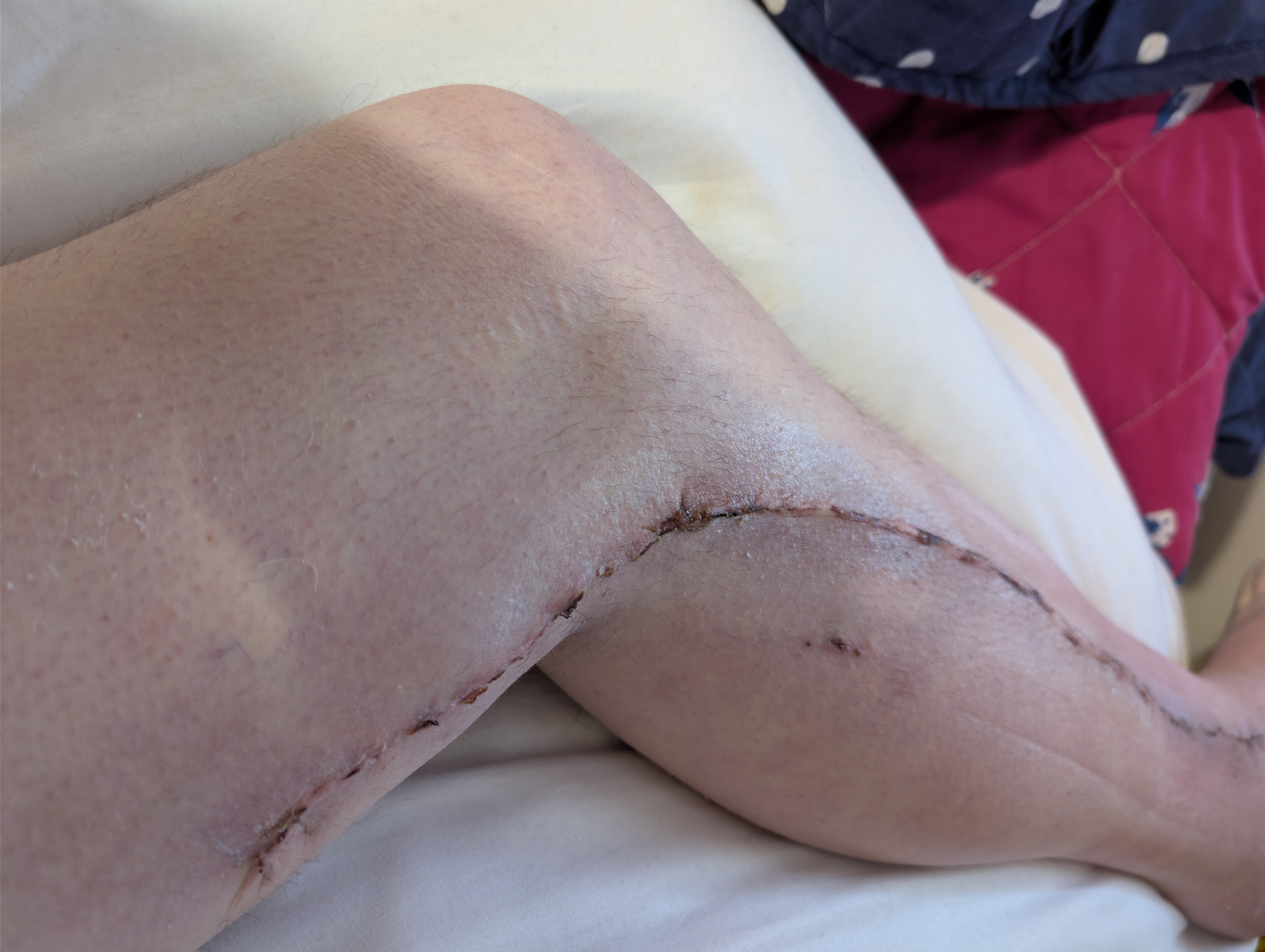 Stitched up 1.