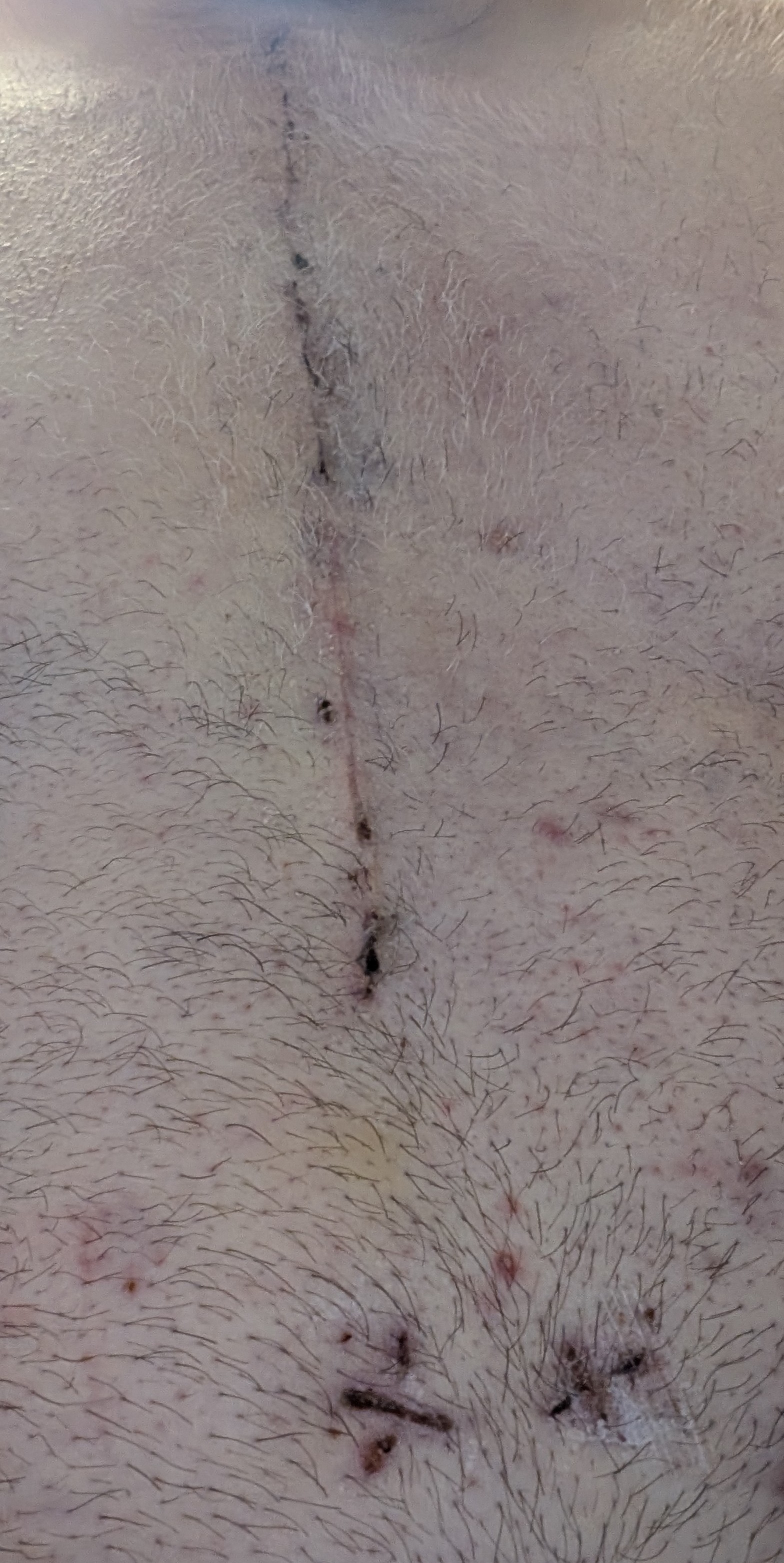 Stitched up 2.